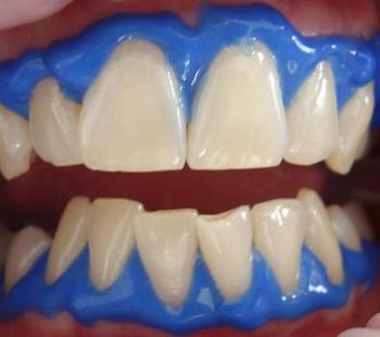 Cosas que debemos saber de los blanqueamientos dentales.